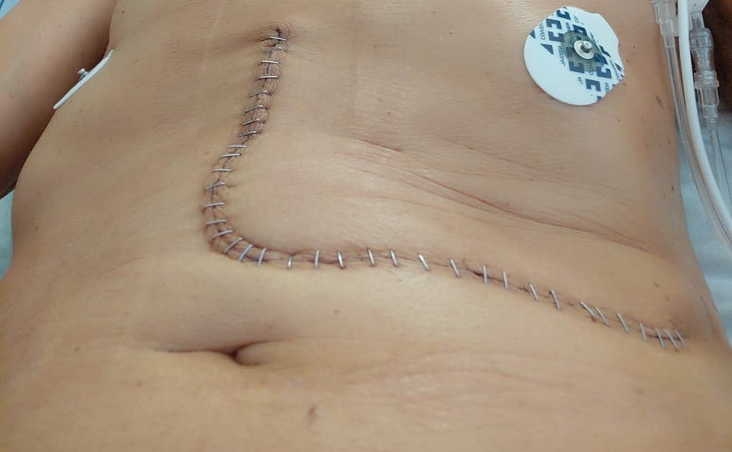 Glidelås på magen? Nei - det var vist stifter i stede for søm.